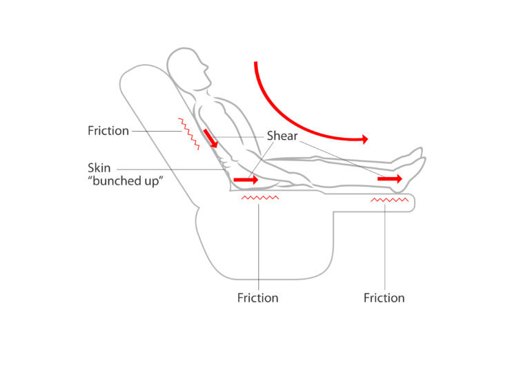 Pressure Care – Why It’s Important – Occupational Therapy